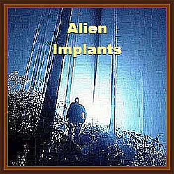 Listing of Implant Related Topics